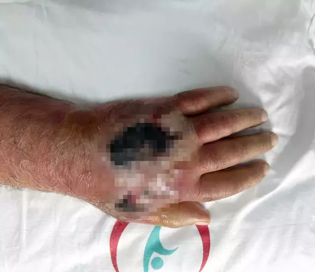Doktorlar bile şaşırdı! Hırsız elini öyle bir ısırdı ki vaka literatüre girmeye hazırlanıyor