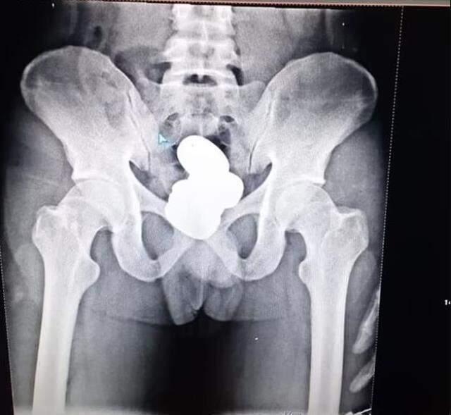 Havalimanında yakalanan kaçakçının makatından 4 kapsül halinde 1 kiloya yakın altın çıktı