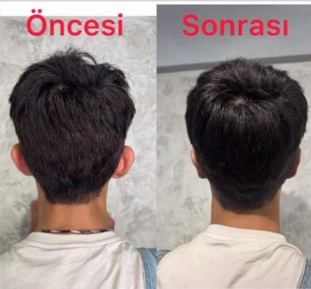 Estetikle bambaşka birine dönüşen fenomen Taha Duymaz, kulaklarını da yaptırdı! İşte son hali