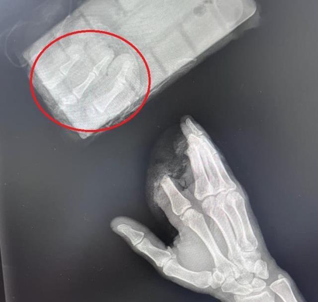 Elini giyotin makasına kaptırdı, kopan parmaklarını poşetle hastaneye götürdü