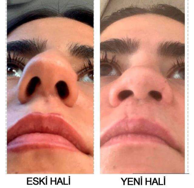 Burun estetiği yaptıran kadının hayatı karardı, pişkin doktor ise 'Düğün hediyem olsun' dedi