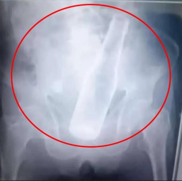 Olayın nedeni daha da ilginç! Acı içinde hastaneye gelen yaşlı adamın makatından bira şişesi çıktı