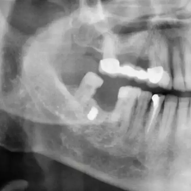 YANAĞINA SAPLANAN METAL PARÇASIYLA 15 YIL YAŞADI