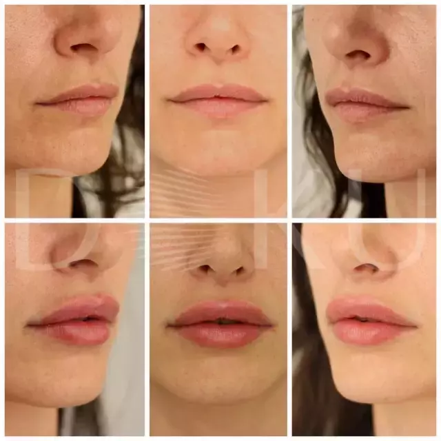 Doku Medical - Dudak Dolgusu ve Burun Dolgusu Uygulamaları Ameliyat Gerektirir Mi?