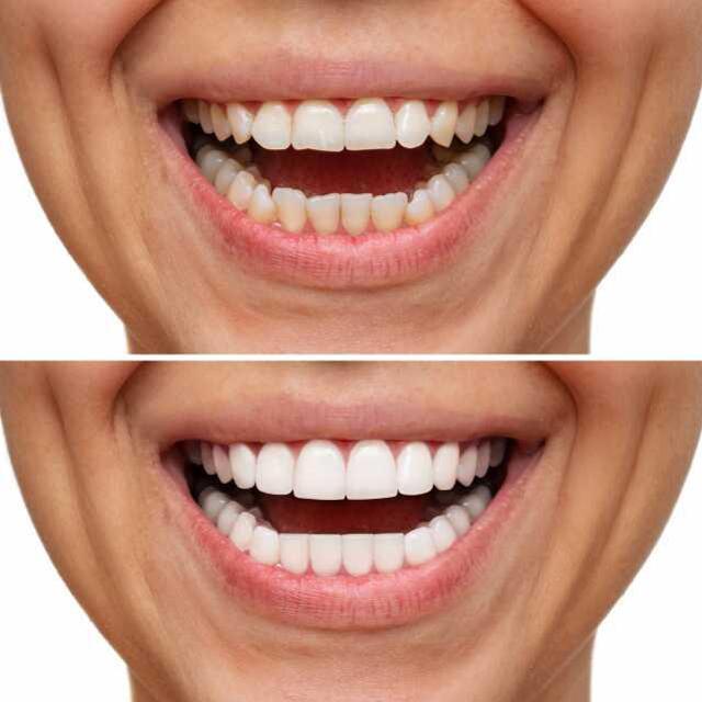 What is the Hollywood smile method? How much is a Hollywood smile in İstanbul, Turkey?