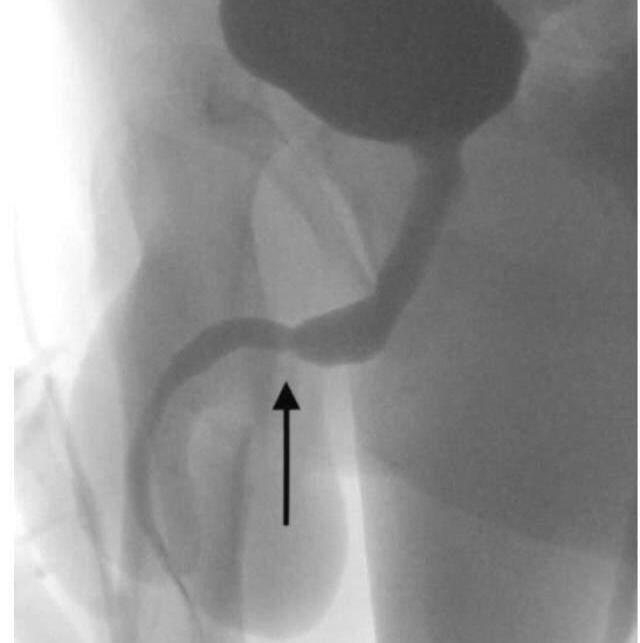 Annesinden günlerce gizledi! Penis boyunu ölçmek amacıyla içine kablo sokan çocuk hastanelik oldu