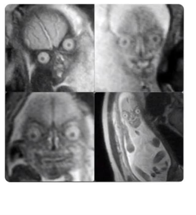Anne karnındaki bebeğin ultrason görüntüsü, ilk kez görenleri ürküttü! Kalbi olan bakmasın