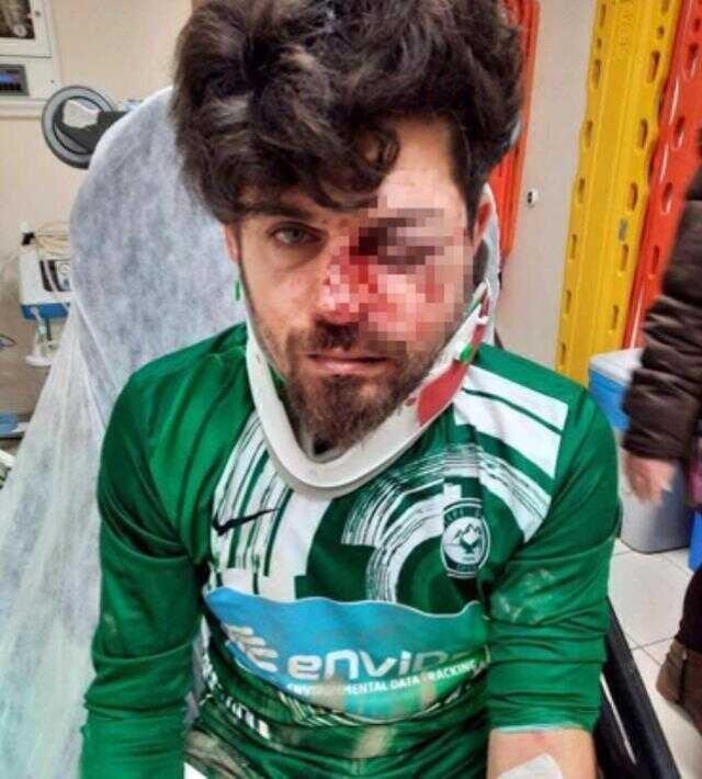 Kırmızı kart gören futbolcu, yerde yatan rakibinin yüzüne tekme atıp yaraladı