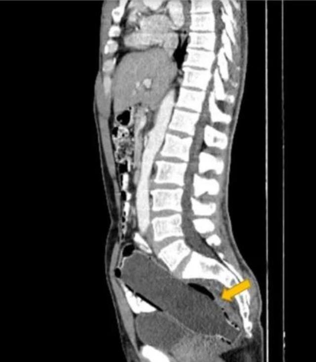 Doktorlar, 3 gündür tuvalete çıkamayan adamın makatında 12 santimetrelik pet şişe buldu