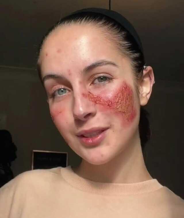 Kendisine karşı alerjisi olan kadın, güldüğünde yüzü yanıp yara oluyor