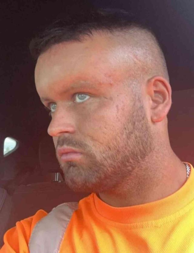 Saç boyasına alerjik reaksiyon gösteren adamın kafası, çizgi film karakterine döndü