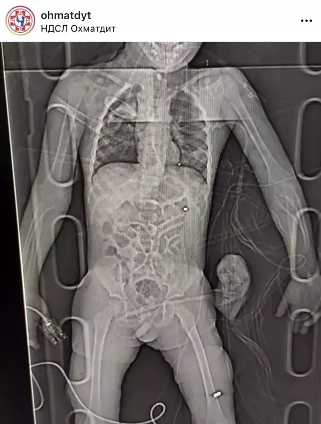 Savaşın korkunç yüzü! Rus bombalarıyla ağır yaralanan çocuğun fotoğrafları yürek parçaladı