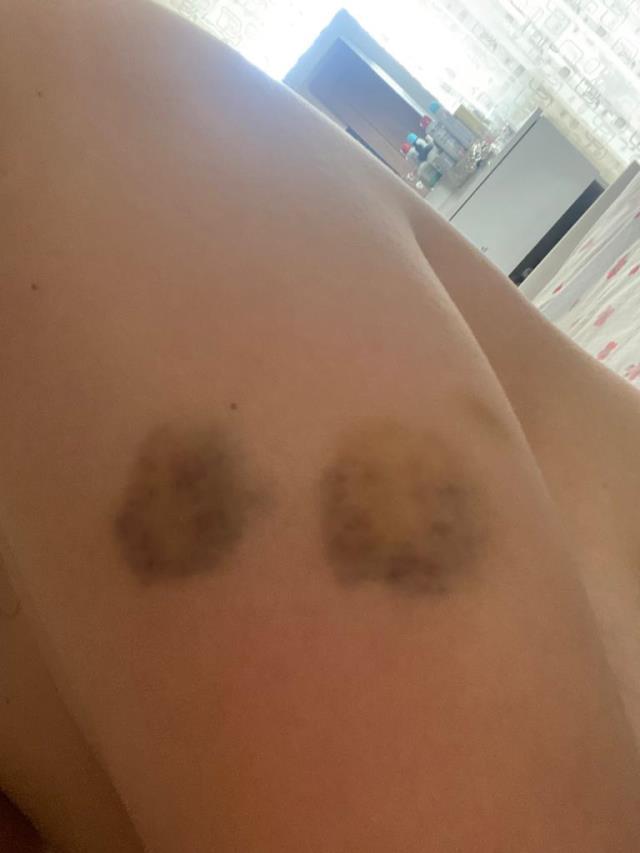 ABB çalışanının eşinden darp iddiası: Beni dövdü, belediye görevlileriyle gelip tehdit etti