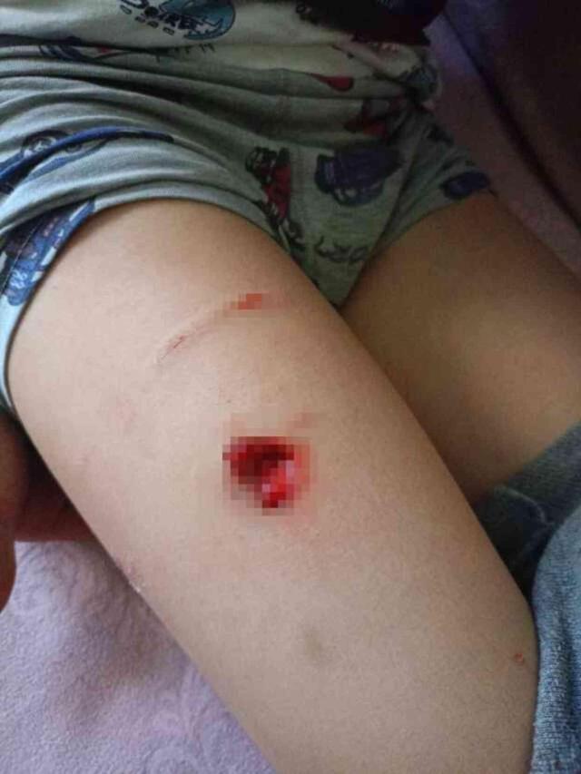 Başıboş köpeklerin saldırısına uğrayan küçük çocuk canını zor kurtardı