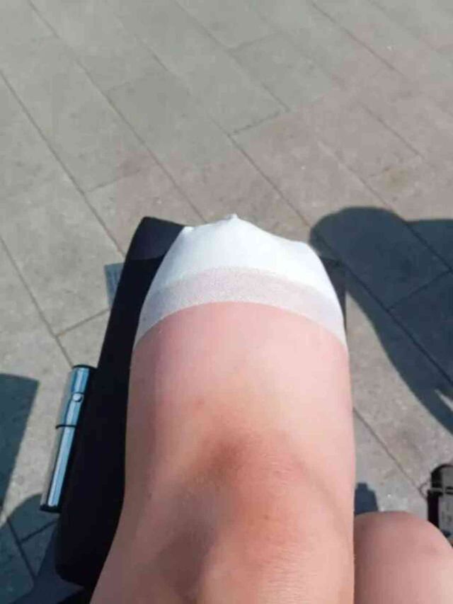 Giydiği spor ayakkabıdan dolayı ayağında kabarcık oluşan kadın, bacağını kaybetti
