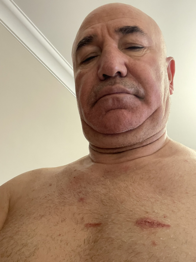 Protesto gösterisine katılan CHP'li Tanal vücudundaki yara izlerini paylaştı