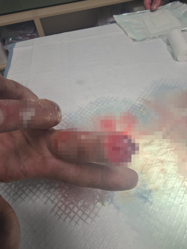 Kopan parmağını buz poşetine koyup yurt dışından Türkiye'ye geldi