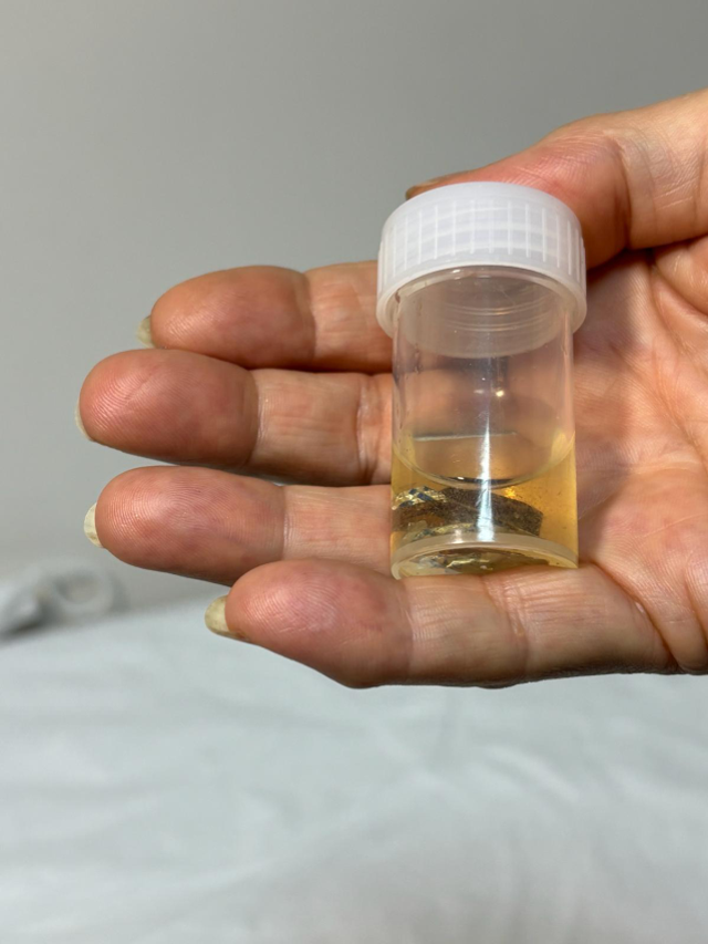 Alüminyum kabıyla yuttuğu hap, 4 yıl sonra akciğerinden çıkarıldı