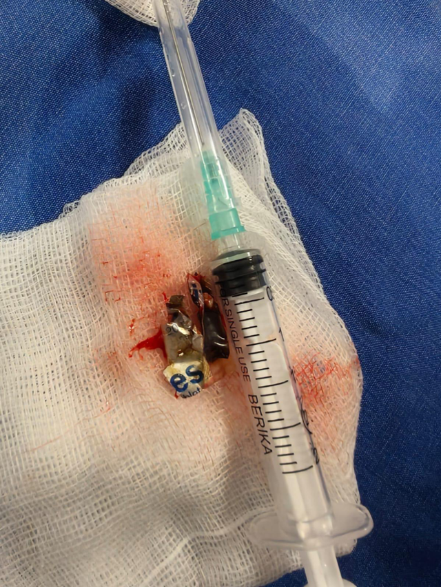 Alüminyum kabıyla yuttuğu hap, 4 yıl sonra akciğerinden çıkarıldı