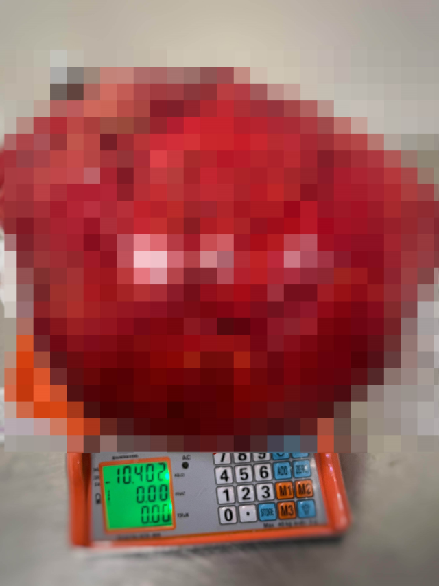 Görenler kilo aldı sandı, karnından 30 santim uzunluğunda 10,5 kiloluk kitle çıktı