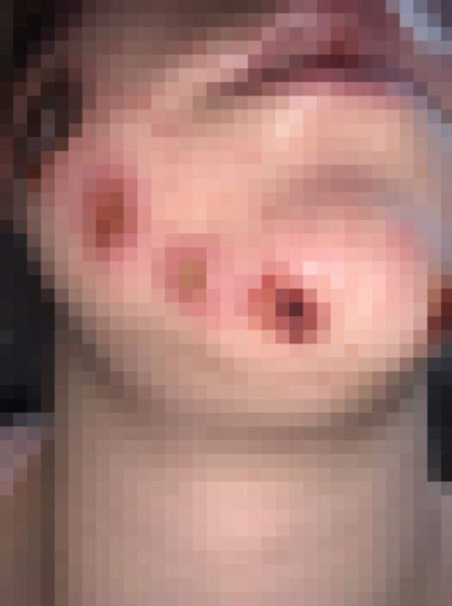 Güzelliği herkesin dilindeydi! Yüzündeki küçük sivilceyle başladı, artık aynaya bile bakamıyor