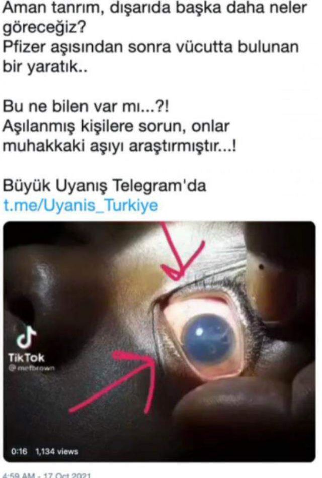 Koronavirüs aşısı olan bir kişinin gözünde solucan oluştuğu iddiası