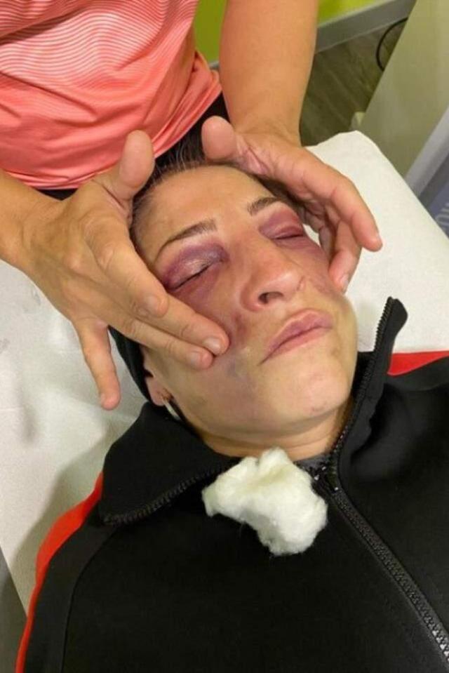 Tam 237 yumruk yedi, nakavt olmadı! Kadın boksörün yüzünün geldiği son hal dehşete düşürdü