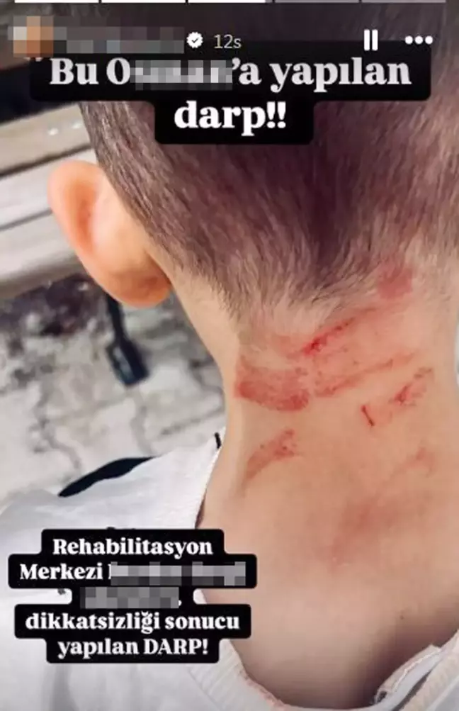 Burdur'da Özel Gereksinimli Çocuğa Darp İddiası: Soruşturma Başlatıldı