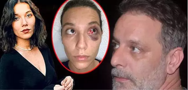 Ozan Güven'in eski kız arkadaşının yüzündeki yaralanma hafif değil