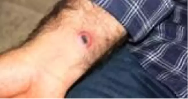 Şarbon nedir? Şarbon hastalığı insanlara bulaşır mı? Şarbon belirtileri neler? Şarbon hastalığı tedavi yöntemleri neler?