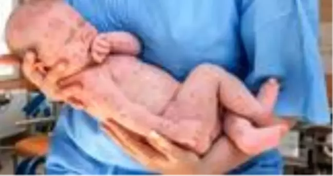 Kızamık hastalığı nedir? Kızamık nasıl olur? Kızamık hastalığı belirtileri nelerdir? Kızamık aşısı yan etkileri nelerdir?