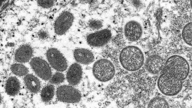 Maymun çiçeği virüsü: İngiltere'de semptomlu kişilere cinsel ilişkiden uzak durmaları tavsiye edildi