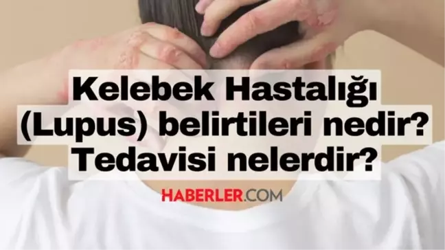 Kelebek hastalığı nedir, neden olur? Lupus hastalığı belirtileri ne, nasıl tedavi edilir?