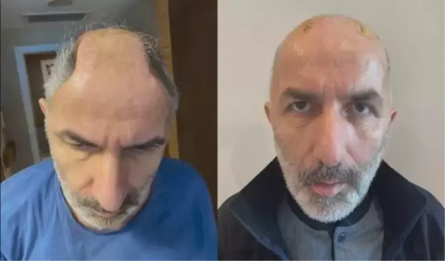 5 ay karnında taşıdığı kafatası kemikleri onu ikinci kez hayata bağladı