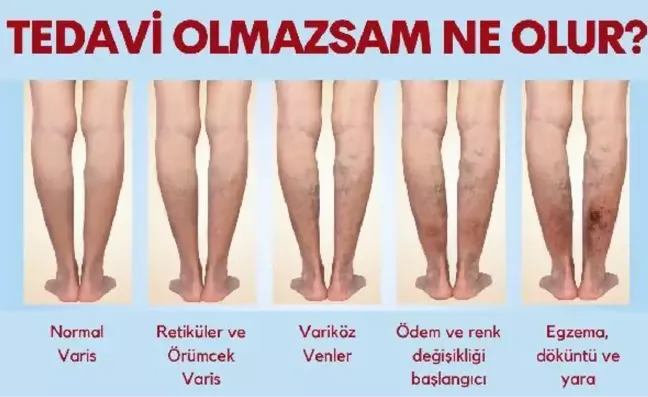 TEDAVİ EDİLMEYEN VARİSE DİKKAT; ÖMÜR BOYU VARİS ÇORABI GİYMEK ZORUNDA KALABİLİRSİNİZ