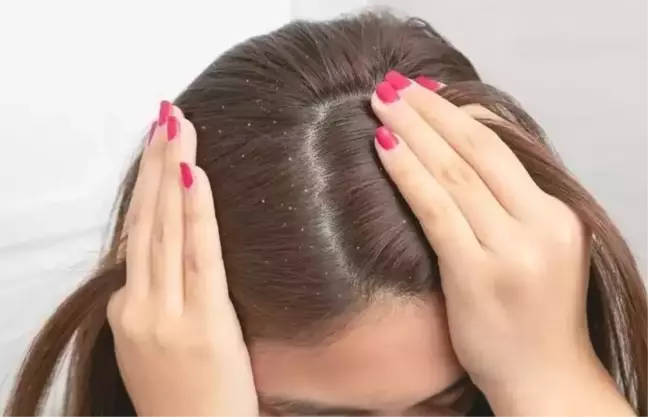 Kepek neden olur, nasıl geçer? Saçta kepek ve kaşıntı nasıl geçer? Kepek nasıl yok olur?