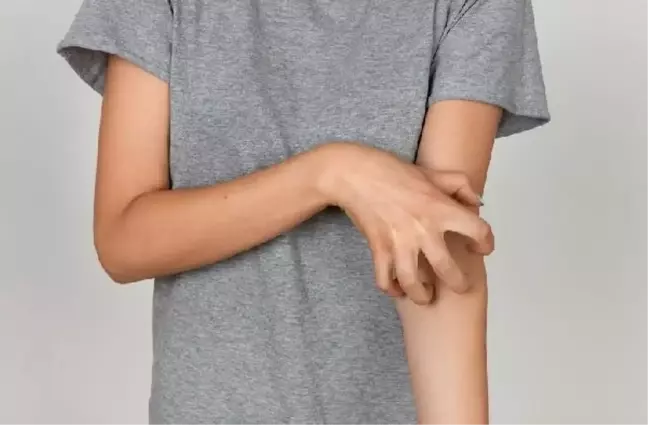 Uyuz Hastalığına Dikkat: Hijyen Önlemleri Alınmalı