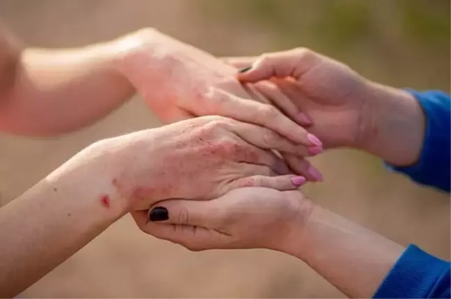 Kelebek Hastalığı nedir? Kelebek Hastalığı belirtisi nedir? Hangi bölüm bakar?