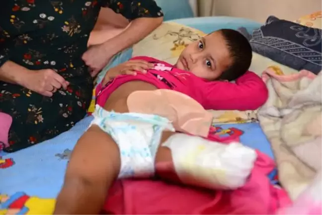 Bacağı kesilen kızına gözyaşlarıyla protez bacak istedi