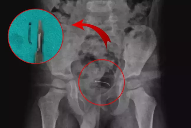 5 yaşındaki çocuğun mesane duvarından çıkan doktorları bile şoke etti