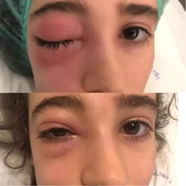 Aybüke, Sinüzite Bağlı Komplikasyon Nedeniyle Kör Oluyordu