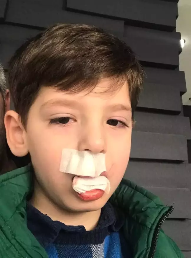 Anaokulunda Oynarken Arkadaşı İtince Dişleri Kırıldı