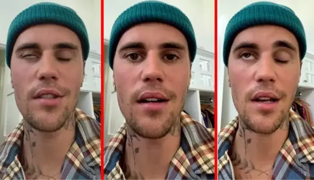 Justin Bieber yüz felci geçirdi! Sadece bir gözünü oynatabiliyor