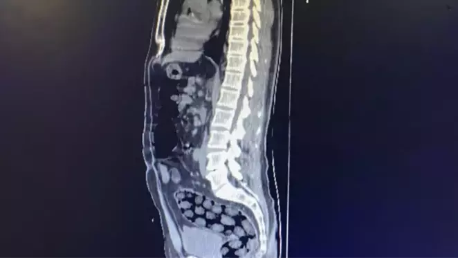 İranlı 3 yolcunun mide ve bağırsaklarından 1 kilo 126 gram metamfetamin çıktı