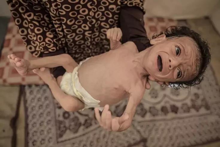 24 saatte 6 kişi daha açlıktan öldü, 7 aylık Salim bebeğin hayatı tehlike altında