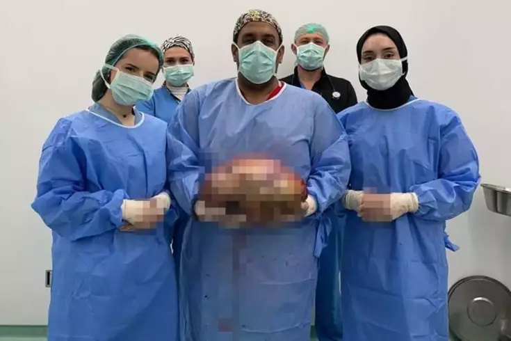 Şişlik yüzünden gitti, karnından çıkan doktorları bile şoke etti