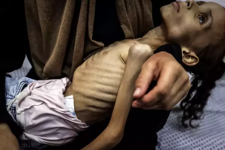 İnsanlığı utandıracak görüntüler! Gazzeli Meryem yavaş yavaş ölüyor