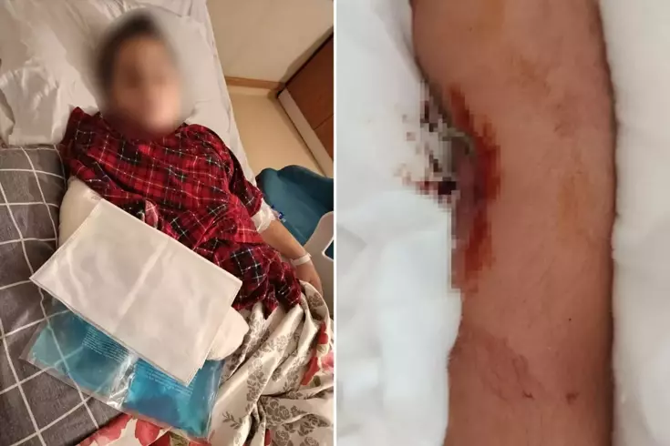 9 yaşındaki çocuk, 8 yaşındaki çocuğun kolunu kırarak intikam aldı