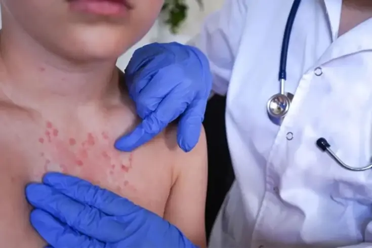 Vakalar pik yaptı! İki haftada ortaya çıkıyor, 3 yıl kadar sürüyor