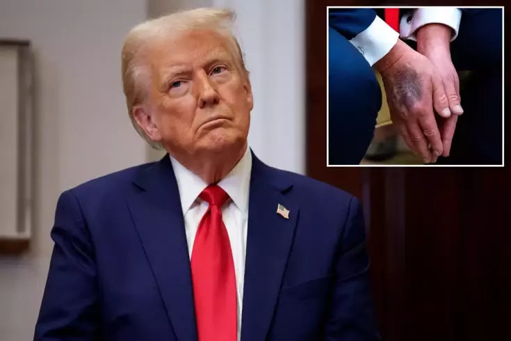 Trump explained the reason for his bruises for the first time.